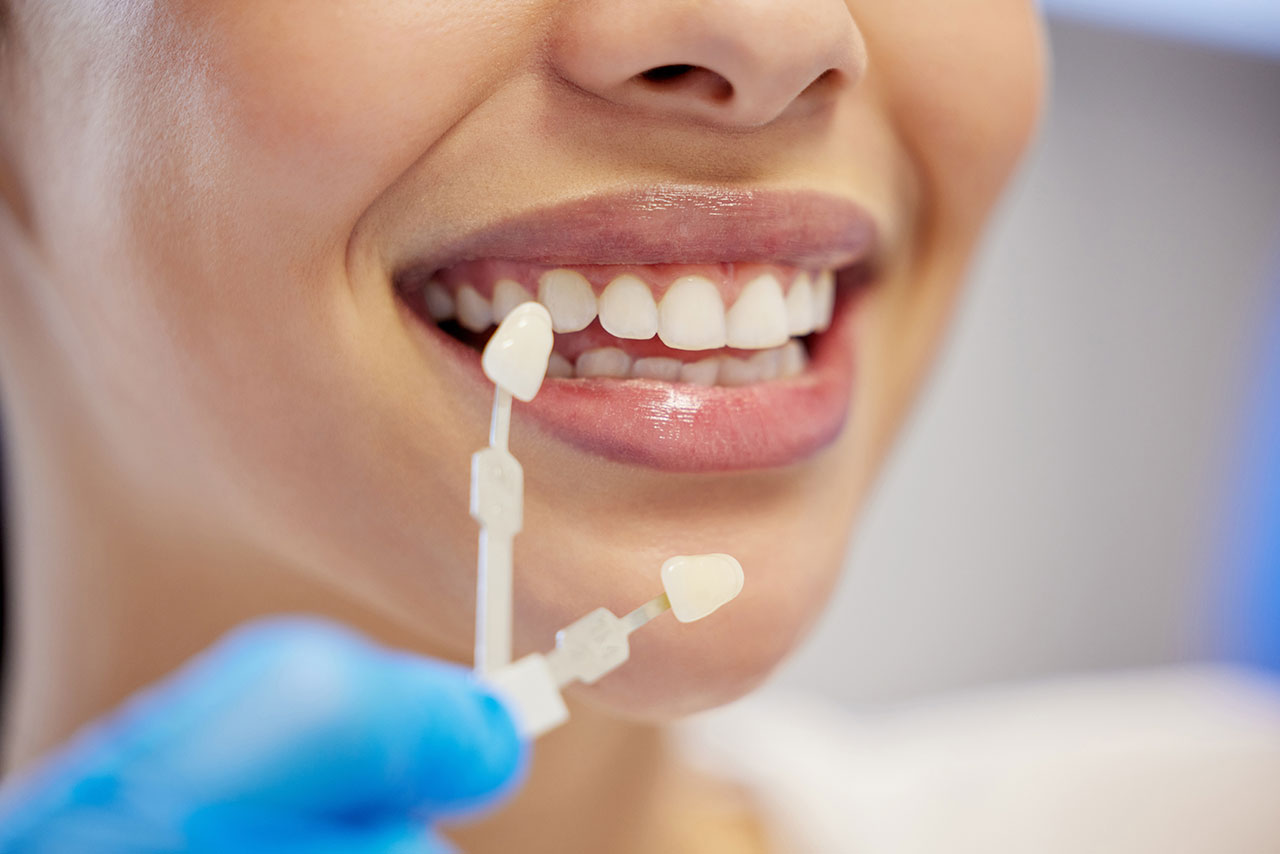 Dental Bonding vs Veneers: Choosing the Right Cosmetic Dentistry Solution