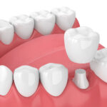 Unique Smiles of McHenry | When Is a Dental Crown the Right Solution for a Damaged Tooth?