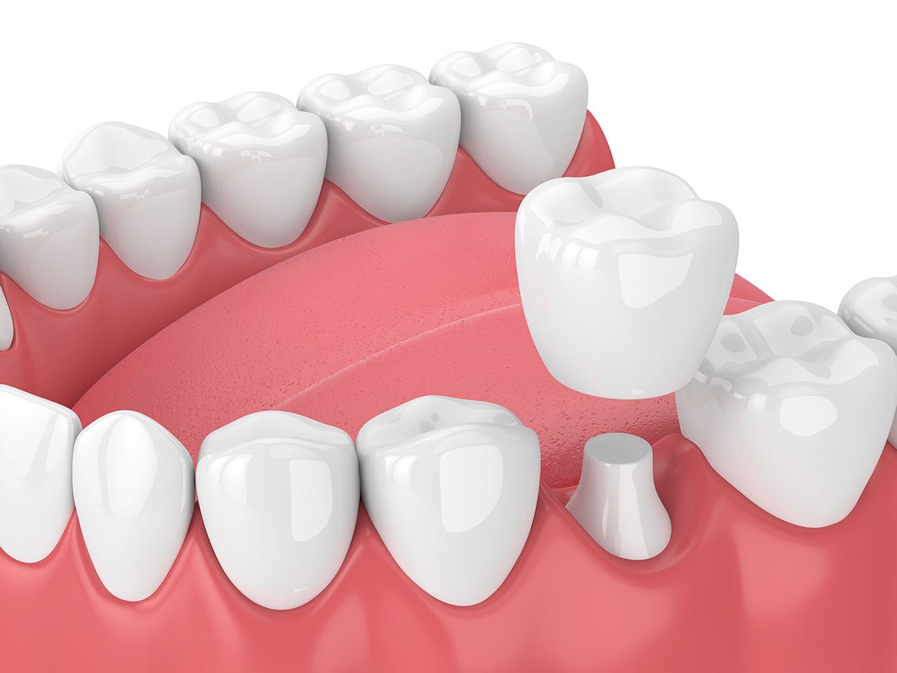 Unique Smiles of McHenry | When Is a Dental Crown the Right Solution for a Damaged Tooth?