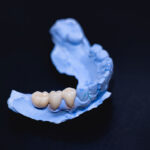 Unique Smiles of McHenry | Dental Bridges in McHenry: How They Replace Missing Teeth and Restore Your Bite