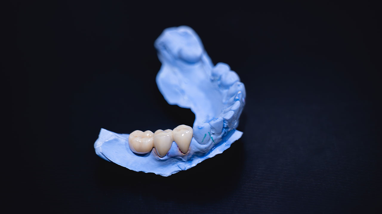 Unique Smiles of McHenry | Dental Bridges in McHenry: How They Replace Missing Teeth and Restore Your Bite Unique Smiles of McHenry | Dental Bridges in McHenry: How They Replace Missing Teeth and Restore Your Bite