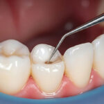 Unique Smiles of McHenry | Air Abrasion Dentistry in McHenry: A Gentle Alternative for Treating Small Cavities